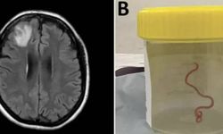 Avustralya'da bir kadının beyninden 8 santimetrelik canlı solucan çıkarıldı