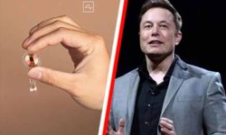 Dünya’da 12 kişiye Elon Musk’ın beyin çipi yerleştirildi