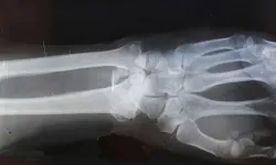 Çin’de kırık kemiği 3 dakikada onaran yapıştırıcı geliştirildi