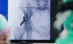 Dünyada bir ilk: Hollanda’da 3D yazıcıyla üretilen kalça implantı insana takıldı