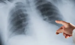 Avusturya’da yanlış teşhis skandalı: Hasta sağlıklı akciğerini kaybetti