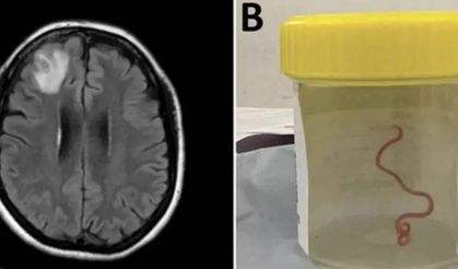Avustralya'da bir kadının beyninden 8 santimetrelik canlı solucan çıkarıldı
