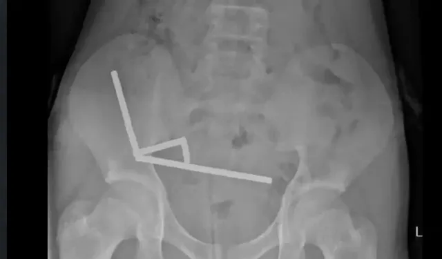 İnternetten aldığı mıknatısları yutan çocuk ölümden döndü
