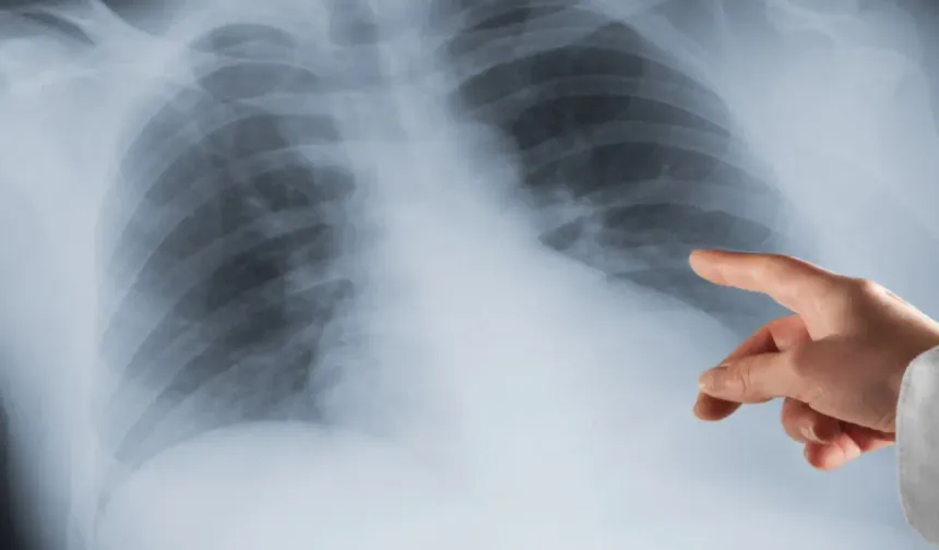 Avusturya’da yanlış teşhis skandalı: Hasta sağlıklı akciğerini kaybetti