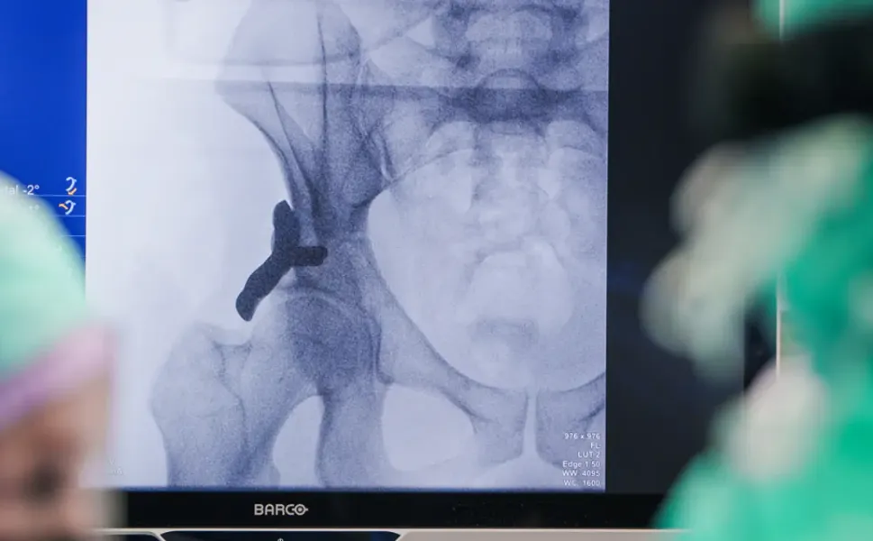 Dünyada bir ilk: Hollanda’da 3D yazıcıyla üretilen kalça implantı insana takıldı