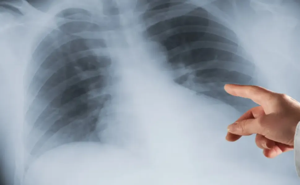 Avusturya’da yanlış teşhis skandalı: Hasta sağlıklı akciğerini kaybetti